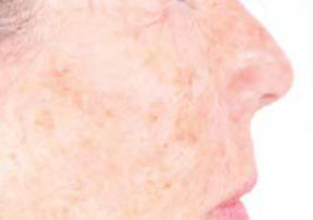 skin after treatment