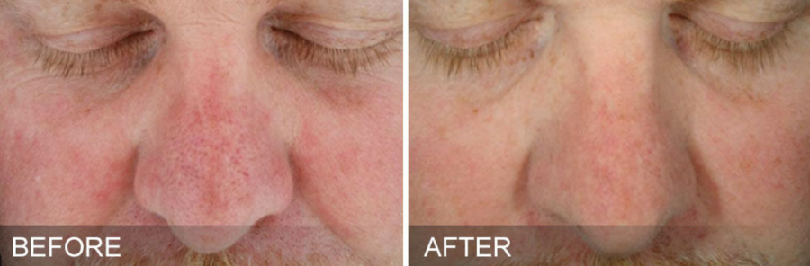 Before and After 01 Hydrafacial