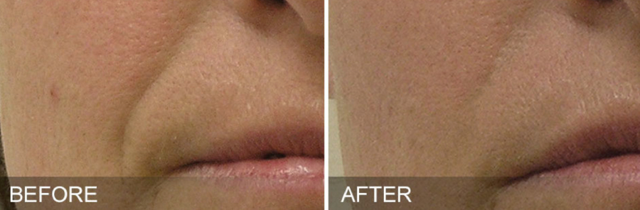 Before and After 03 Hydrafacial