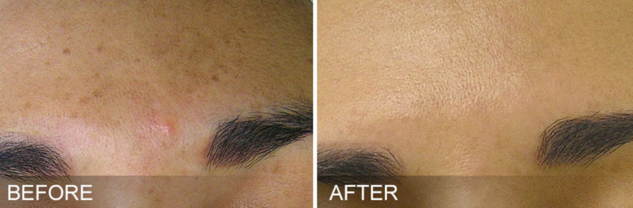 Before and After 05 Hydrafacial