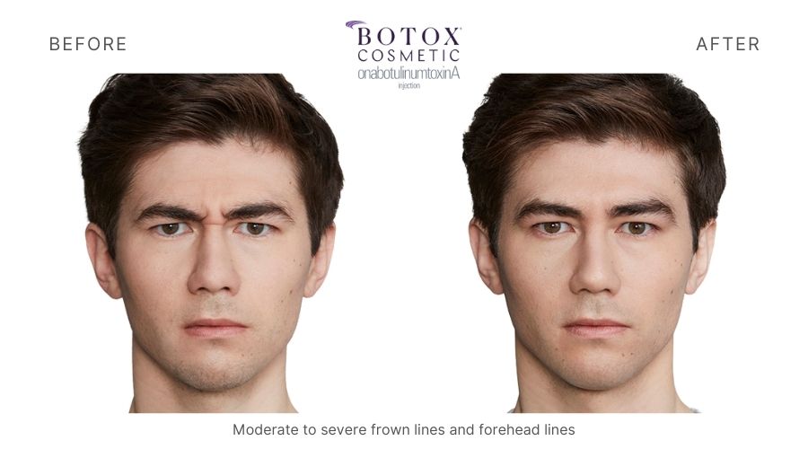 Botox Before and After 4