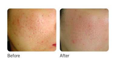 Before and After Microneedling