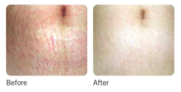 Before and After Microneedling