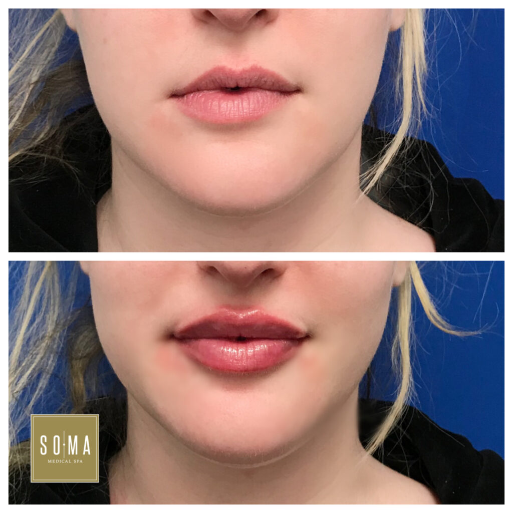 Dermal Fillers Dermal Fillers Near Me Glendale CA Soma Med spa